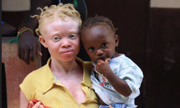 Tanzania: la casa che salva ragazzi albini
